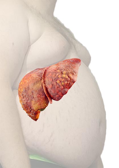 Fatty liver